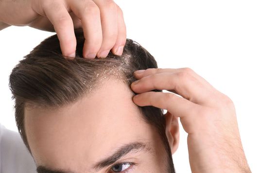 5 Effective Solutions for Hair Fall and Dandruff Problems