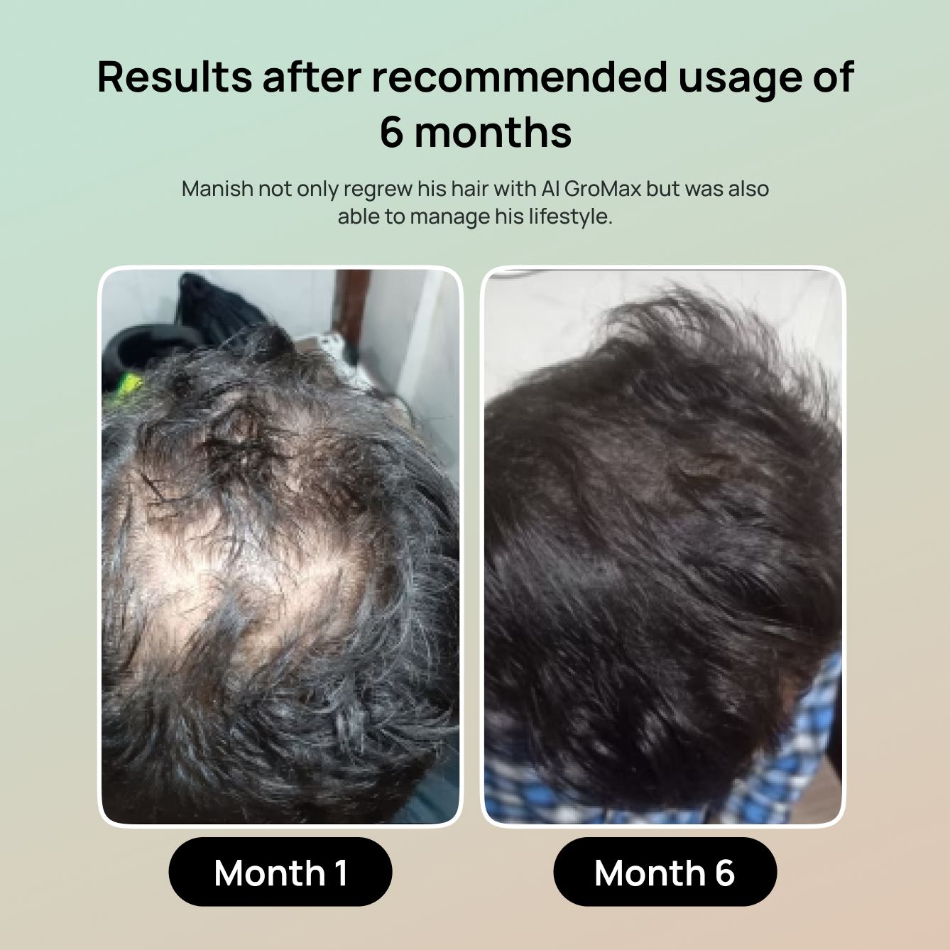 Minoxidil 5% + Hair Growth App